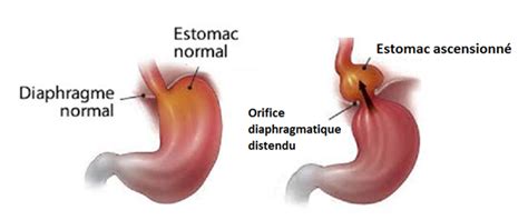 Hernie Hiatale Et Reflux Gastro Sophagien Centre De Chirurgie