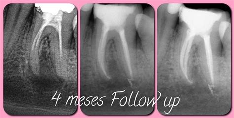 Follow Up De Retratamento Endodôntico De 1o Molar Com Lesão Apical