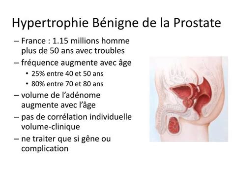 Ppt Hypertrophie B Nigne De La Prostate Powerpoint Presentation Free