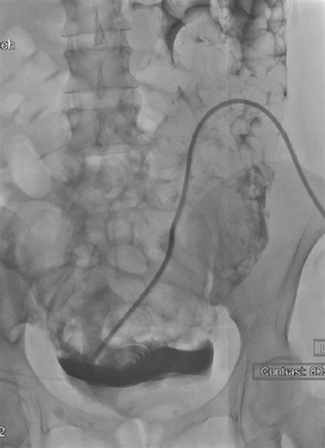 Interventional Radiology Placement And Management Of Tunneled