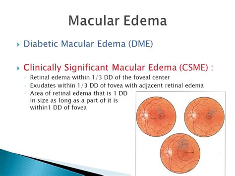 Clinically Significant Macular Edema