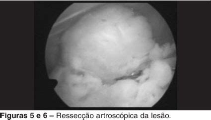 SciELO Brasil Sinovite Vilonodular Pigmentada Localizada Relato De