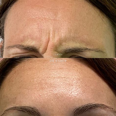 Anti Wrinkle Injections Botox In Melbourne Dr Saber