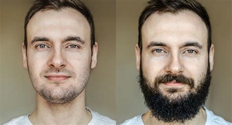 How To Do Beard Transplantation Hair Transplant In Turkey