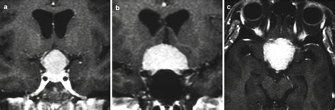 Meningioma Of The Sellar And Parasellar Region Neupsy Key