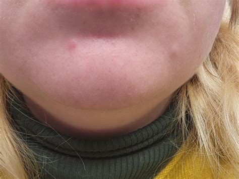 New And Interesting Bumps On Chin I Thought They Were Pimples And Wasn T Paying Attention For A