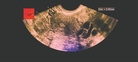 Transvaginal Ultrasound Ovarian Cysts