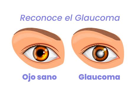 Qu Es El Glaucoma Y C Mo Prevenirlo Cl Nica De Ojos Del Tolima