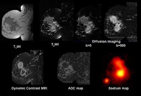 Multiparametric Magnetic Resonance Imaging Of Breast Cancer Journal