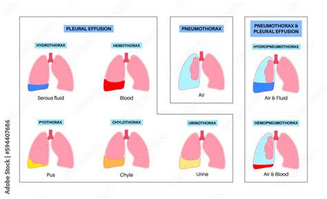 Pleural Effusion Poster Stock Vector Adobe Stock