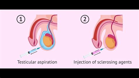 Aspiration Of Bone Cyst Cpt Code Simplify Medical Coding Youtube