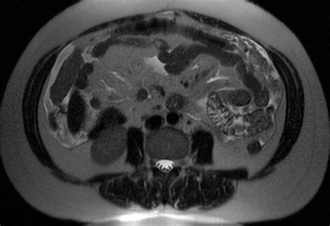 Primary Peritoneal Carcinomatosis Body Mr Case Studies Ctisus Ct