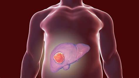 Sex Differences In Hbv Associated Liver Cancer Medical News Group