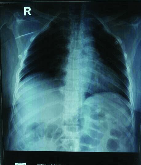 Postero Anterior Chest X Ray Showing Catheter S Tip In Subclavian Vein