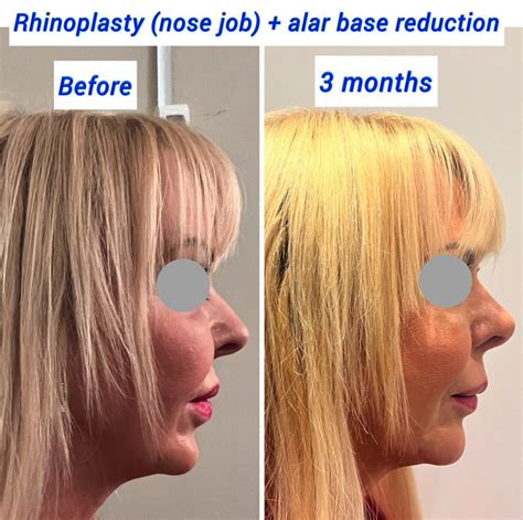 Alar Base Reduction Nostril Reduction Harley Clinic