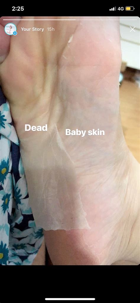 How Often Should You Use Baby Foot Peel - Baby Viewer