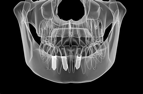 Why Choose Dental Implants - Willow Pass Dental Care