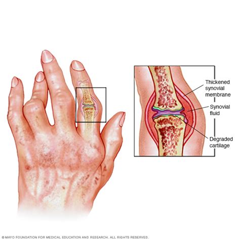 Rheumatoid Arthritis Disease Reference Guide