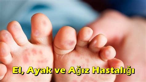 El Ayak ve Ağız Hastalığı Nedir SAĞLIKLI TÜRKİYE