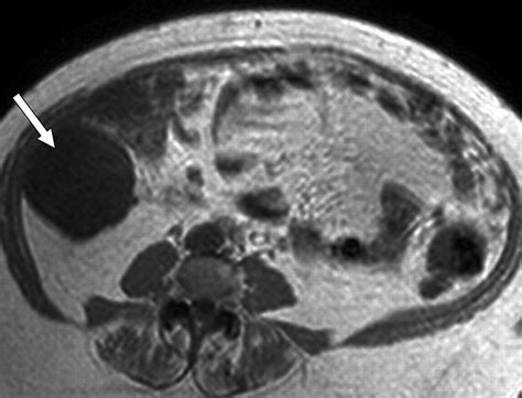 Mucinous Appendiceal Neoplasms Preoperative Mr Staging And