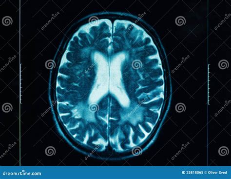 Ct Scan Of The Human Brain Stock Image Image Of Head 25818065