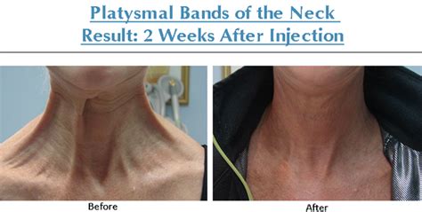 Nefertiti Neck Lift And Platysmal Bands Clinic 1 Colchesters Leading