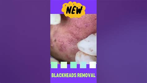 EXTREME BLACKHEADS REMOVAL - FACE #1 - YouTube