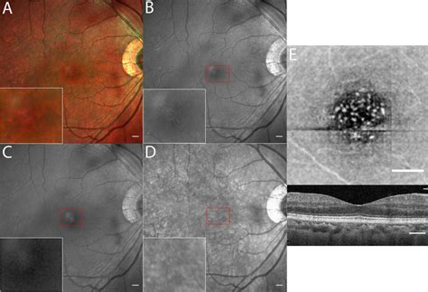 Montage of a right eye with PVD. SLO images including multicolor (A ...