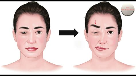 Treatment Of Hemifacial Spasm And Benign Essential Spasm With Botulinum