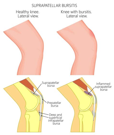 Suprapatellar Bursitis - Causes & Best Treatment Options