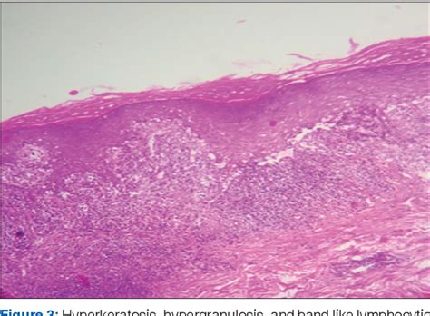 Figure 3 From Histopathological Study Of Non Infectious Papulosquamous