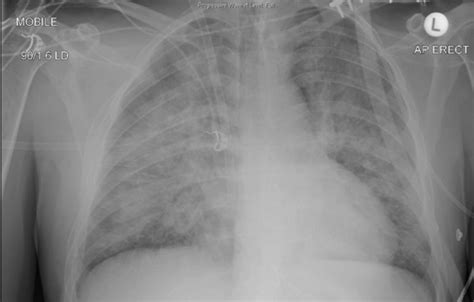 Differential Hypoxia In Reverse Intensive