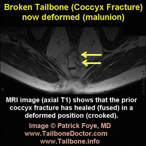 Tailbone MRI Deformed Coccyx Pain Foye A Photo On Flickriver