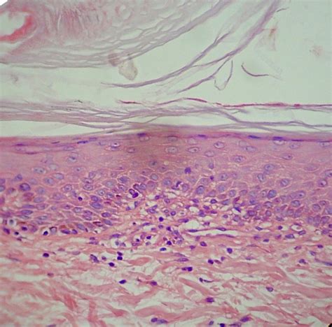 Consulta A Un Colega Nº2 Enfermedad De Flegel Hiperqueratosis