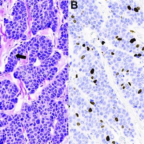 Large Cell Neuroendocrine Carcinoma With Carcinoid Like Morphology