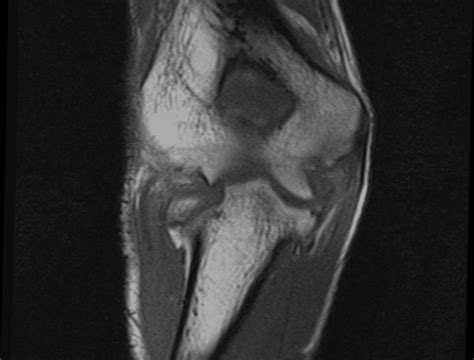 Intraarticular Osteoid Osteoma Of Elbow Joint Associated With Synovitis