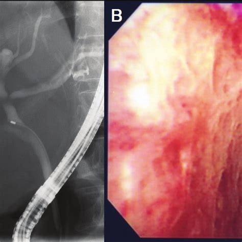 A The Filling Defect Of The Bile Duct Disappeared On Ercp B