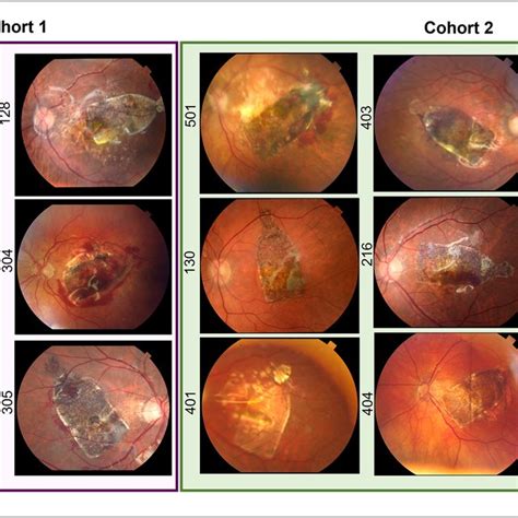 The Cpcb Rpe Implant A The Hesc Derived Rpe Cells Seeded And