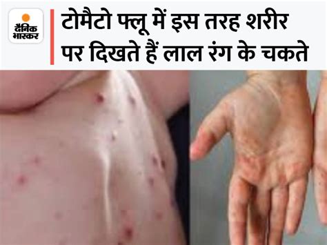 Shimla Alert In Himachal To Prevent Tomato Flu टोमैटो फ्लू से बचाव