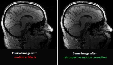 Robin Medical Inc Motion Artifact Correction