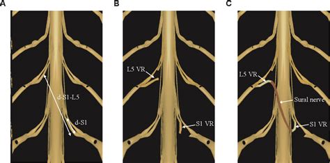 Figure 1 From Extradural Contralateral S1 Nerve Root Transfer For