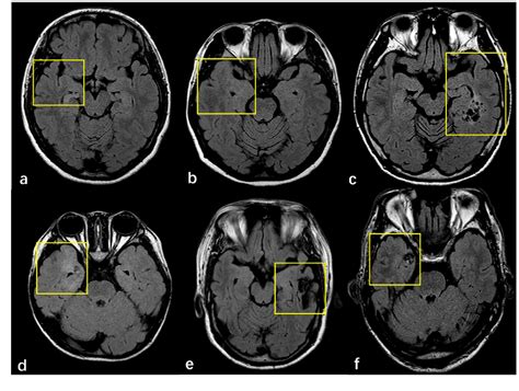 Figure 2 From Focal Cortical Dysplasia Type Ⅲ Related Medically Refractory Epilepsy Mri