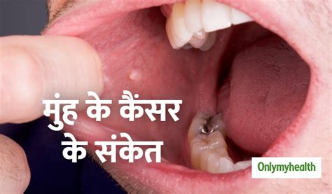 Lips Cancer Ke Lakshan