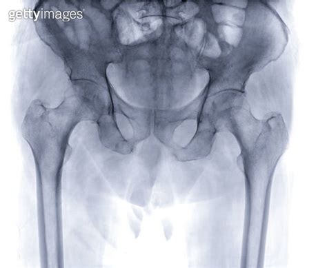 An X Ray Reveals Both Hip Joints In Normal Study