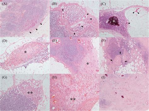 Various Treatment Related Histopathological Findings Of Axillary Lymph