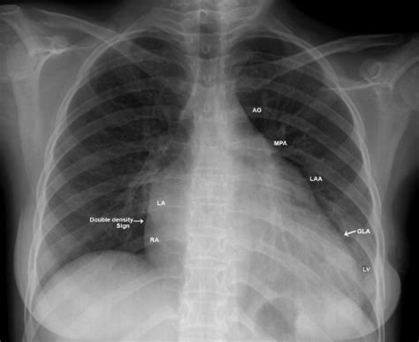 Chest X Ray Enlarged Heart