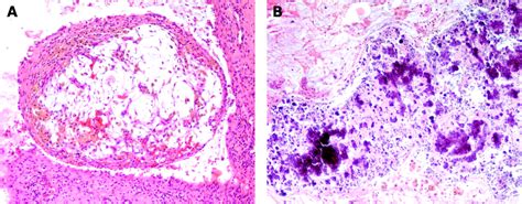 Meconium Induced Periorchitis Bmj Case Reports