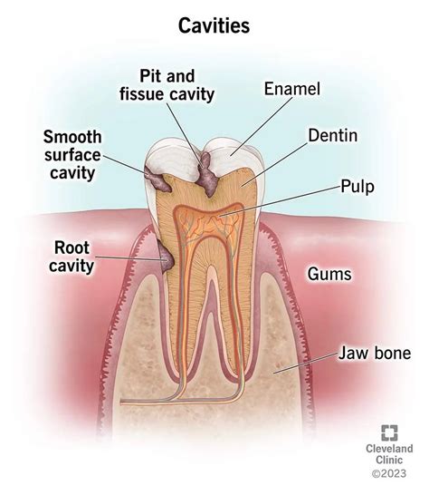 Cavities Tooth Decay Symptoms Causes Treatment