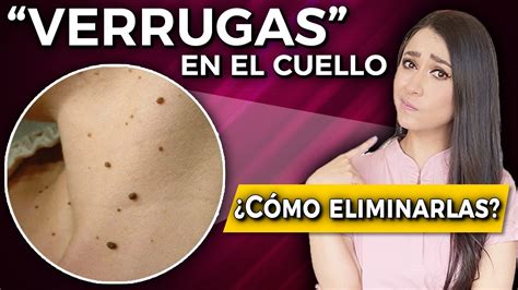 VERRUGAS en el cuello l Cómo ELIMINARLAS qué son y por qué salen