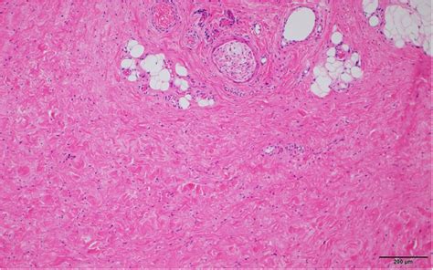 Unilateral Fibrous Hyperplasia Of The Labium Majus In Pre And Early